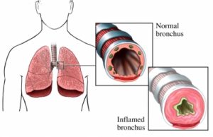 beriliosis pulmonar