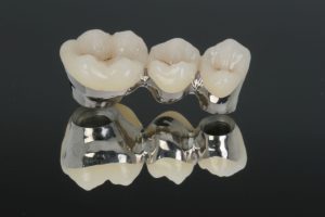 Implantes dentales con base de paladio
